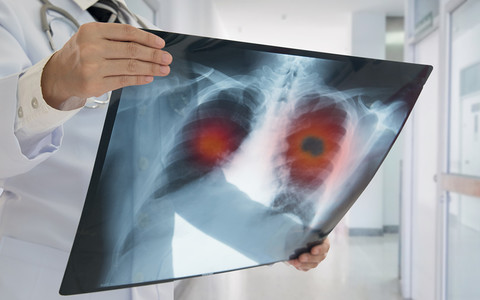 Londyn: Wielkie badanie wykrywające raka płuc