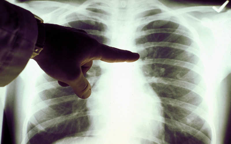NHS to screen for lung cancer in trucks in supermarket car parks