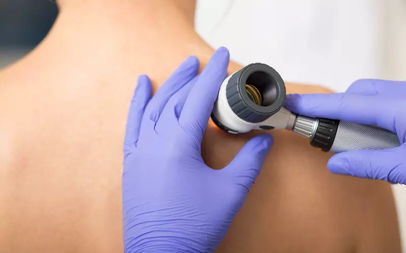 Skin cancer cases hit a record high in England