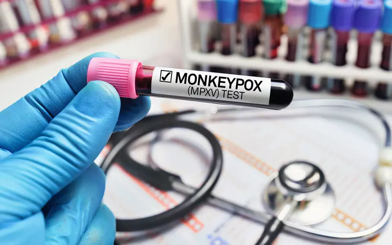 UK monkeypox outbreak is biggest outside Africa and still growing