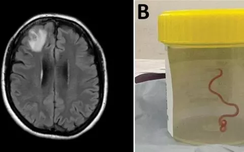 ‘Oh my god’: live worm found in Australian woman’s brain in world-first discovery