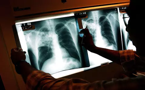 Tuberculosis alert with cases in London at six-year high