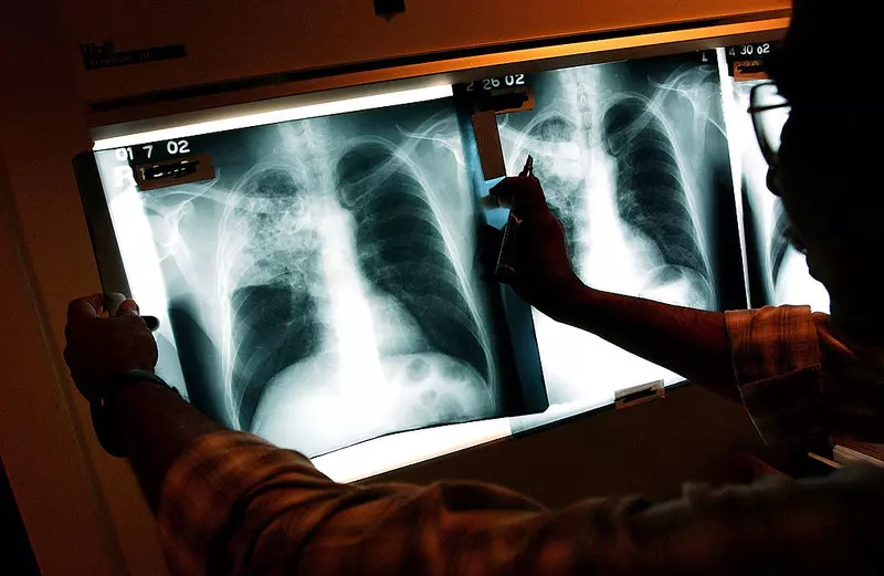 Londyn: Liczba przypadków gruźlicy wciąż rośnie i jest najwyższa w kraju