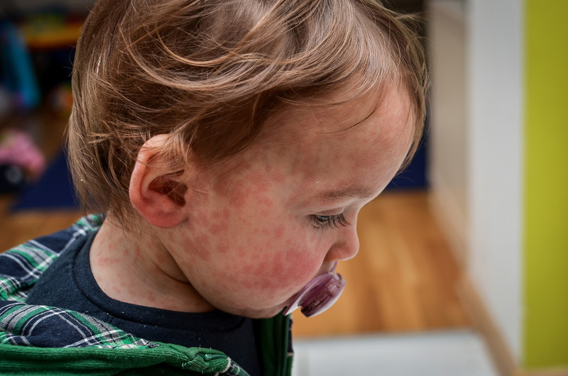 Measles: Why are cases rising in England and what are the symptoms?