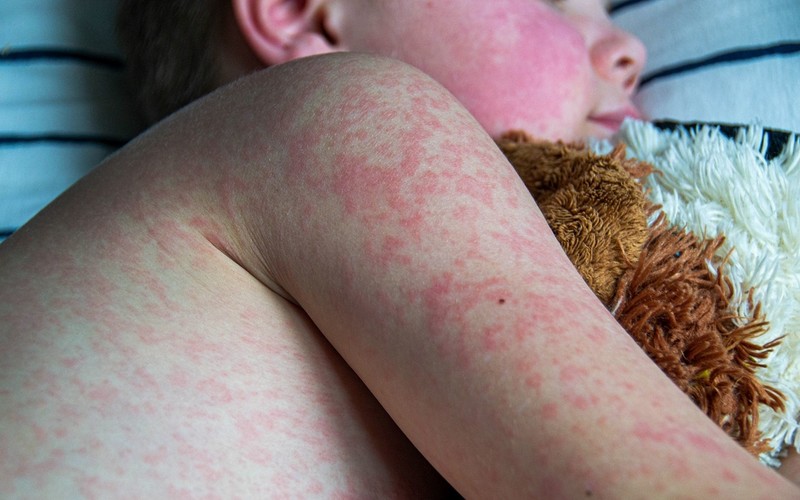 France: Warning of increased risk of measles