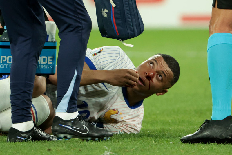 EURO 2024: Mbappe suffers broken nose