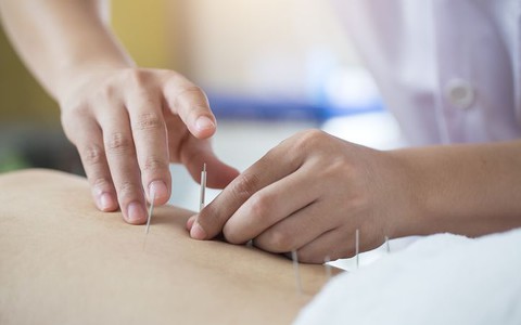 Akupunktura - starożytna metoda na przywrócenie równowagi