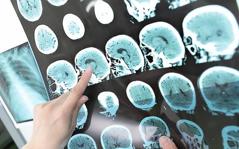 Odszkodowania powypadkowe po urazach głowy i mózgu